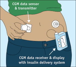 CGM diagram from FDA